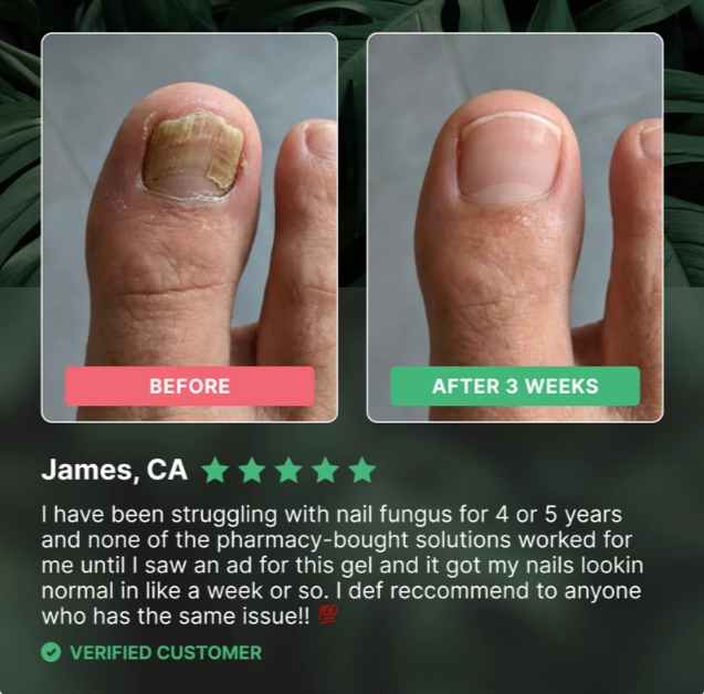 Dermafix Nail Fungus Treatment Gel Customer Reviews