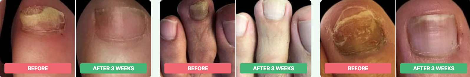 Dermafix Nail Fungus Treatment Gel Customer img