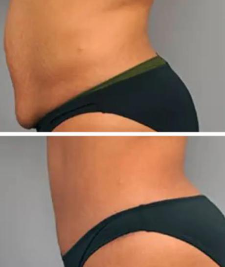 Glokore IPL Body Sculptor Benefits