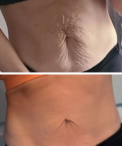 Glokore IPL Body Sculptor Customer 3