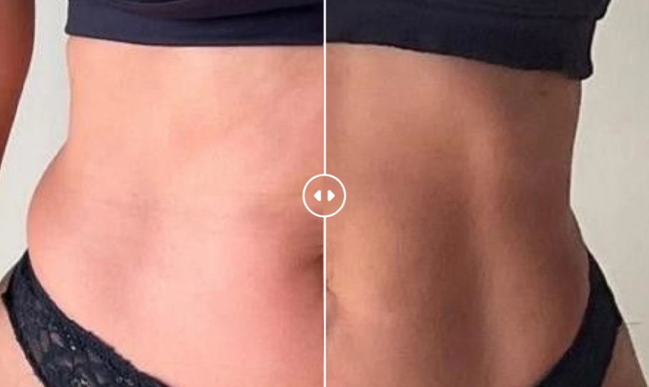 Glokore IPL Body Sculptor results