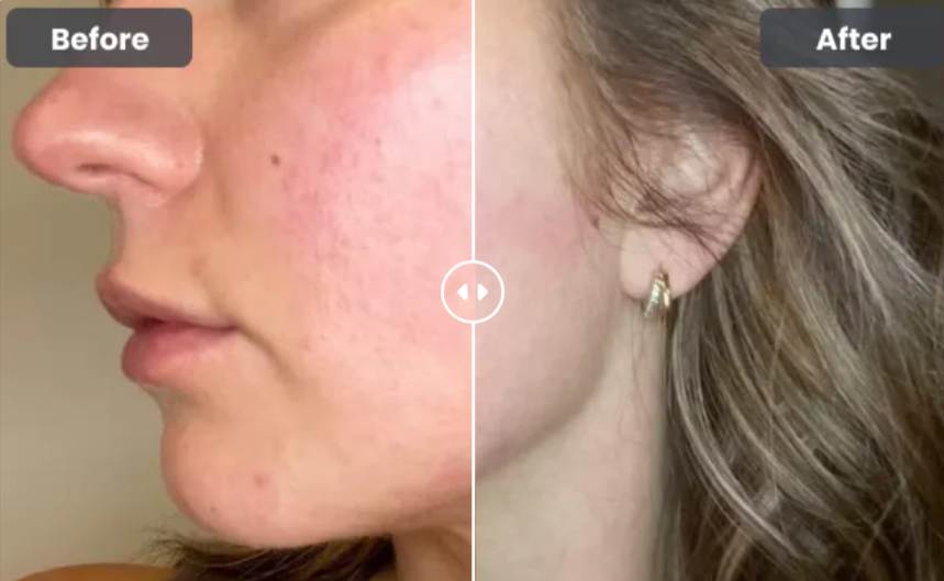 Glokore LED Skin Sculptor Before After