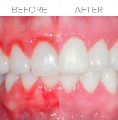 Great Gums BioElectric ToothBrush Before After